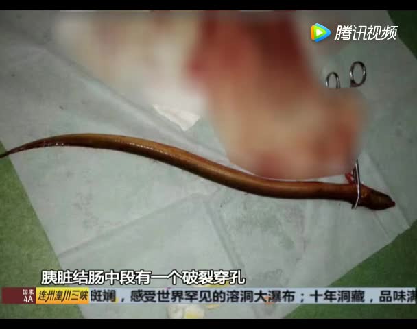 广州一大叔将黄鳝塞肛门 不料钻入腹腔差点要了命
